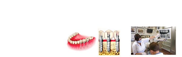 dental implants