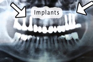 dental implants xray
