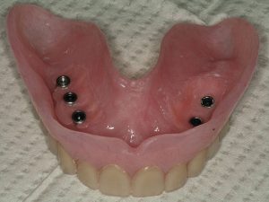 implant retained overdenture