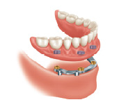 Mini dental implant with reinforcement bar and retained lower denture Mini dental implant with reinforcement bar and retained lower denture