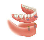 mini dental implant retained dentures mini dental implant retained dentures